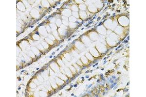 Immunohistochemistry of paraffin-embedded Human colon using PDGFB Polyclonal Antibody at dilution of 1:100 (40x lens). (PDGFB anticorps)