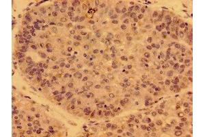 Immunohistochemistry of paraffin-embedded human liver cancer using ABIN7162766 at dilution of 1:100 (GDF15 anticorps  (AA 16-143))