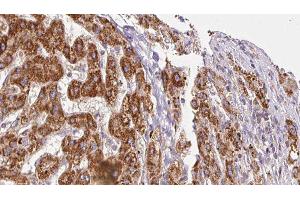 ABIN6278311 at 1/100 staining Human liver cancer tissue by IHC-P.