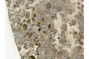 ABIN6260308 and ABIN6272258 at 1/100 staining human melanoma by IHC-P. (BRD3 anticorps  (C-Term))