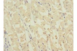 Immunohistochemistry of paraffin-embedded human gastric cancer using ABIN7162039 at dilution of 1:100 (NME3 anticorps  (AA 20-169))
