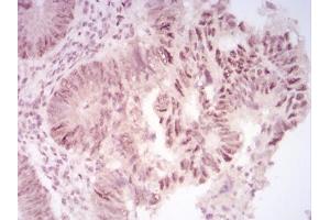 Immunohistochemical analysis of paraffin-embedded rectum cancer tissues using CBX2 mouse mAb with DAB staining. (CBX2 anticorps  (AA 402-525))