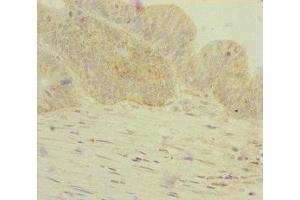 Immunohistochemistry of paraffin-embedded human colon cancer using ABIN7154305 at dilution of 1:100 (GORASP2 anticorps  (AA 353-452))