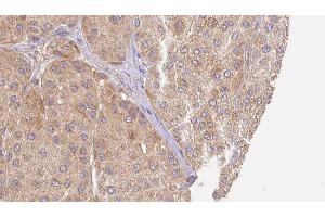 ABIN6277537 at 1/100 staining Human Melanoma tissue by IHC-P. (LUM anticorps  (N-Term))