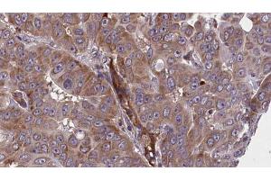 ABIN6273609 at 1/100 staining Human liver cancer tissue by IHC-P. (BIN2 anticorps  (Internal Region))
