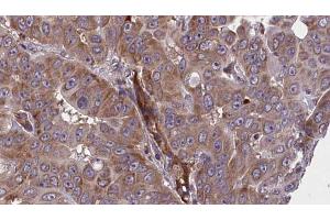 ABIN6273609 at 1/100 staining Human liver cancer tissue by IHC-P.