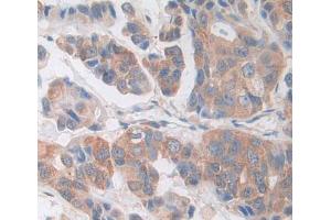 IHC-P analysis of breast cancer tissue, with DAB staining. (CDK18 anticorps  (AA 144-425))