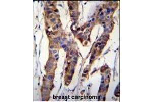 ZBT24 Antibody (N-term) (ABIN655829 and ABIN2845247) immunohistochemistry analysis in formalin fixed and paraffin embedded human breast carcinoma followed by peroxidase conjugation of the secondary antibody and DAB staining.