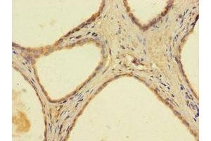 Immunohistochemistry of paraffin-embedded human prostate cancer using ABIN7144667 at dilution of 1:100