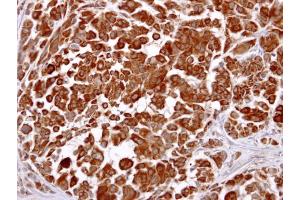 IHC-P Image LHR antibody [C3], C-term detects LHR protein at cytosol on human lung carcinoma by immunohistochemical analysis. (LHCGR anticorps  (C-Term))