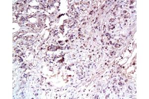 Formalin-fixed and paraffin embedded human gastric carcinoma labeled Anti-C-Met Polyclonal Antibody, Unconjugated  at 1:100, followed by conjugation to the secondary antibody and DAB staining
