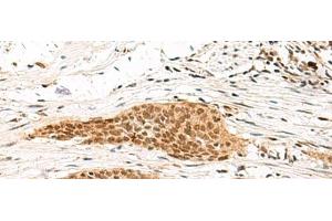 Immunohistochemistry of paraffin-embedded Human esophagus cancer tissue using MDFI Polyclonal Antibody at dilution of 1:55(x200) (MDFI anticorps)