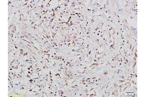 Formalin-fixed and paraffin embedded: human lung carcinoma labeled with Anti-IGF1R/CD221 Polyclonal Antibody, Unconjugated  at 1:300, followed by conjugation to the secondary antibody and DAB staining