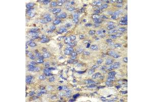 Immunohistochemistry of paraffin-embedded human liver cancer using SDHA antibody.