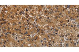 Immunohistochemistry of paraffin-embedded Human liver cancer tissue using TAB1 Polyclonal Antibody at dilution 1:40 (TAB1 anticorps)