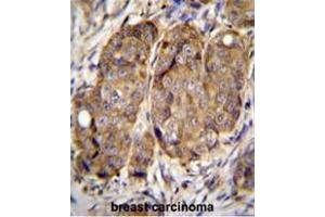 METTL2 Antibody (C-term) immunohistochemistry analysis in formalin fixed and paraffin embedded human breast carcinoma followed by peroxidase conjugation of the secondary antibody and DAB staining.