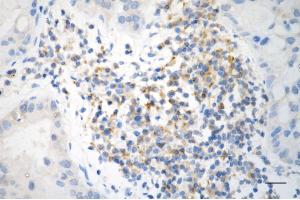 Immunohistochemistry was performed on paraffin-embedded human lung adenocarcinoma using BAX antibody (ABIN7797748), 1:200).