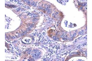 IHC-P Image LDH-B antibody detects LDHB protein at cytosol on human gastric cancer by immunohistochemical analysis. (LDHB anticorps)