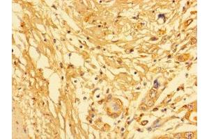 Immunohistochemistry of paraffin-embedded human pancreatic cancer using ABIN7157217 at dilution of 1:100