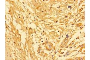 Immunohistochemistry of paraffin-embedded human pancreatic cancer using ABIN7157217 at dilution of 1:100 (Kallikrein 6 anticorps  (AA 22-244))