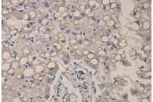 Immunohistochemical staining of formalin-fixed paraffin-embedded liver showing membrane staining with anti-GnT-V antibody dilution: 1/200.