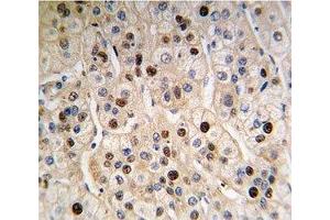 IHC analysis of FFPE human hepatocarcinoma tissue stained with anti-PCNA antibody (PCNA anticorps  (AA 89-117))