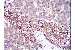 Immunohistochemical analysis of paraffin-embedded liver cancer tissues using FGG mouse mAb with DAB staining.