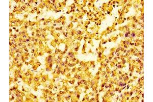 Immunohistochemistry of paraffin-embedded human colon cancer using nme1HU at dilution of 1:100