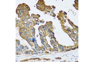 Immunohistochemistry of paraffin-embedded human colon carcinoma using SLC25A13 antibody. (slc25a13 anticorps  (AA 1-300))