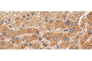 Immunohistochemistry of paraffin-embedded Human liver cancer tissue using PDHA1 Polyclonal Antibody at dilution of 1:50(x200) (PDHA1 anticorps)