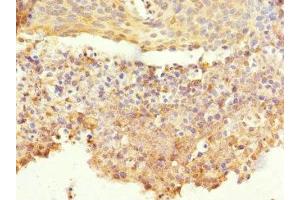 Immunohistochemistry of paraffin-embedded human cervical cancer using ABIN7148605 at dilution of 1:100 (CORO1C anticorps  (AA 375-474))