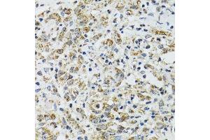 Immunohistochemistry of paraffin-embedded human uterine cancer using TXN2 antibody. (TXN2 anticorps  (AA 1-166))