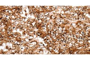 Immunohistochemistry of paraffin-embedded Human renal cancer tissue using SLC9A3R2 Polyclonal Antibody at dilution 1:40