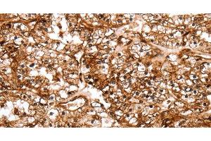 Immunohistochemistry of paraffin-embedded Human renal cancer tissue using SLC9A3R2 Polyclonal Antibody at dilution 1:40 (SLC9A3R2 anticorps)