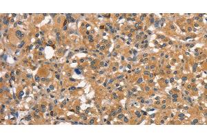 Immunohistochemistry of paraffin-embedded Human thyroid cancer using DNM2 Polyclonal Antibody at dilution of 1:40