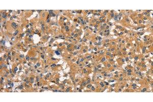 Immunohistochemistry of paraffin-embedded Human thyroid cancer using DNM2 Polyclonal Antibody at dilution of 1:40 (DNM2 anticorps)