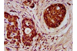 IHC image of ABIN7152390 diluted at 1:300 and staining in paraffin-embedded human pancreatic cancer performed on a Leica BondTM system.