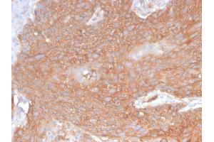 Formalin-fixed, paraffin-embedded human Pancreatic Cancer stained with Spectrin beta III Rabbit Recombinant Monoclonal (SPTBN2/2894R).