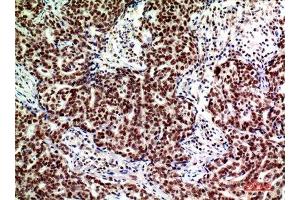 Immunohistochemistry (IHC) analysis of paraffin-embedded Human Breast Cancer, antibody was diluted at 1:200.