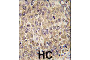 Formalin-fixed and paraffin-embedded human hepatocellular carcinoma reacted with AFP polyclonal antibody  , which was peroxidase-conjugated to the secondary antibody, followed by DAB staining. (alpha Fetoprotein anticorps  (N-Term))