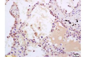 Formalin-fixed and paraffin embedded human lung carcinoma labeled with Rabbit Anti phospho-SHC(Tyr239/240) Polyclonal Antibody, Unconjugated (ABIN745973) at 1:200 followed by conjugation to the secondary antibody and DAB staining (SHC1 anticorps  (pTyr349, pTyr350))