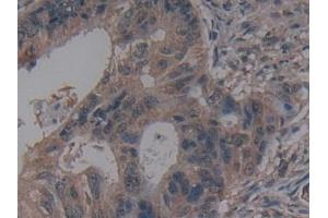 Detection of ANO6 in Human Colorectal cancer Tissue using Polyclonal Antibody to Anoctamin 6 (ANO6)