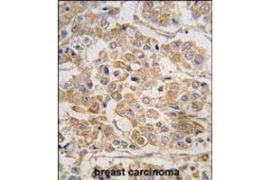 Formalin-fixed and paraffin-embedded human breast carcinoma tissue reacted with IKKE Antibody (C-term) (ABIN392751 and ABIN2842204) , which was peroxidase-conjugated to the secondary antibody, followed by DAB staining. (IKKi/IKKe anticorps  (C-Term))