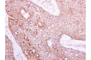 IHC-P Image NOX1 antibody detects NOX1 protein at cytoplasm on human lung carcinoma by immunohistochemical analysis. (NOX1 anticorps)