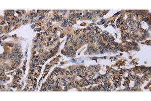 Immunohistochemistry of paraffin-embedded Human breast cancer tissue using DDX11 Polyclonal Antibody at dilution 1:30 (DDX11 anticorps)