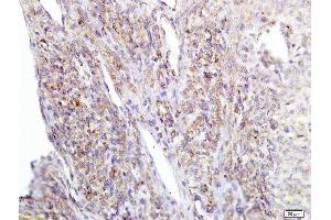 Formalin-fixed and paraffin embedded human cervical carcinoma labeled with Anti APE/Girdin Polyclonal Antibody, Unconjugated  at 1:200 followed by conjugation to the secondary antibody and DAB staining (Girdin anticorps  (AA 1401-1500))