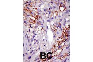 Formalin-fixed and paraffin-embedded human cancer tissue reacted with USP22 polyclonal antibody  , which was peroxidase-conjugated to the secondary antibody, followed by DAB staining . (USP22 anticorps  (C-Term))