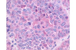 Anti-GRPR antibody IHC of human Lung, Non-Small Cell Carcinoma.