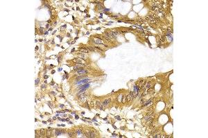 Immunohistochemistry of paraffin-embedded human colon cancer using IRF6 antibody at dilution of 1:200 (400x lens). (IRF6 anticorps)