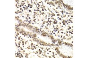 Immunohistochemistry of paraffin-embedded human gastric cancer using LMNB2 Antibody (ABIN5973877) at dilution of 1/200 (40x lens). (Lamin B2 anticorps)